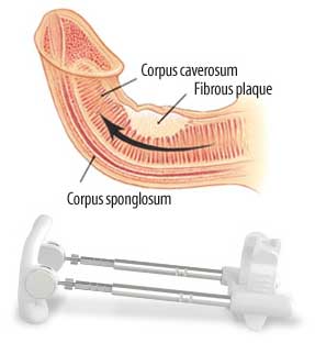 bent penis, peyronies disease, sizegenetics, penile curvature, penis length