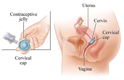 cervical caps, diaphragms, spermicide, toxic shock syndrome, TSS