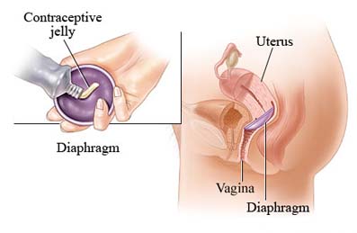 diaphragms, cervical caps, spermicide, contraception, TSS