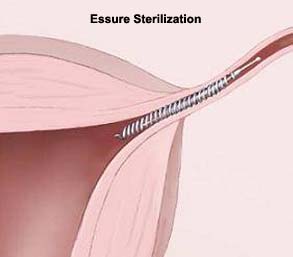 essure, hysteroscopic sterilization, adiana