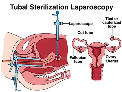 female sterilization, Tubal Ligation, minilaparotomy, laparoscopy