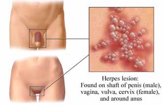 genital herpes, oral herpes, herpes, HSV2, HSV1