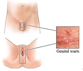 genital warts, HPV, human papillomavirus, cervical cancer, cryotherapy