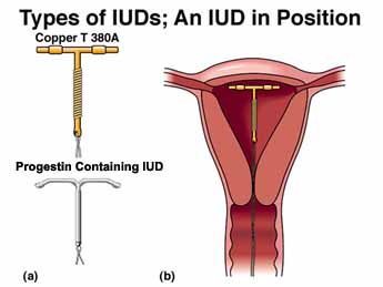 IUD, intrauterine devices, Copper T, mirena, paragard