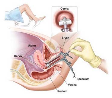 pap smear, pap test, cervical cancer, genital warts, hysterectomy