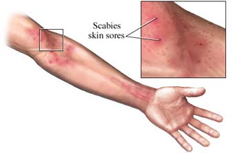 scabies, crusted scabies, sarcoptes scabiei, ivermectin, permethrin