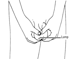 testicular cancer self examination, testicular self examination, enlarged testicles, testes