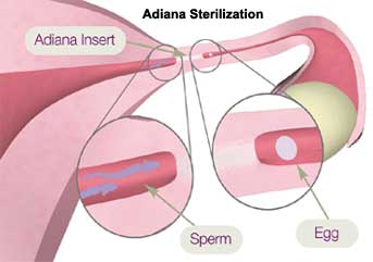 adiana, hysteroscopic sterilization, essure adiana, hysteroscopic sterilization, essure