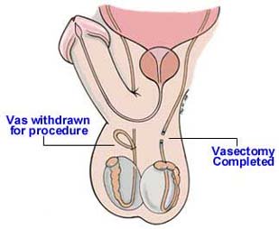 male sterilization, vasectomy, scrotum, vas deferens, seminal fluid
